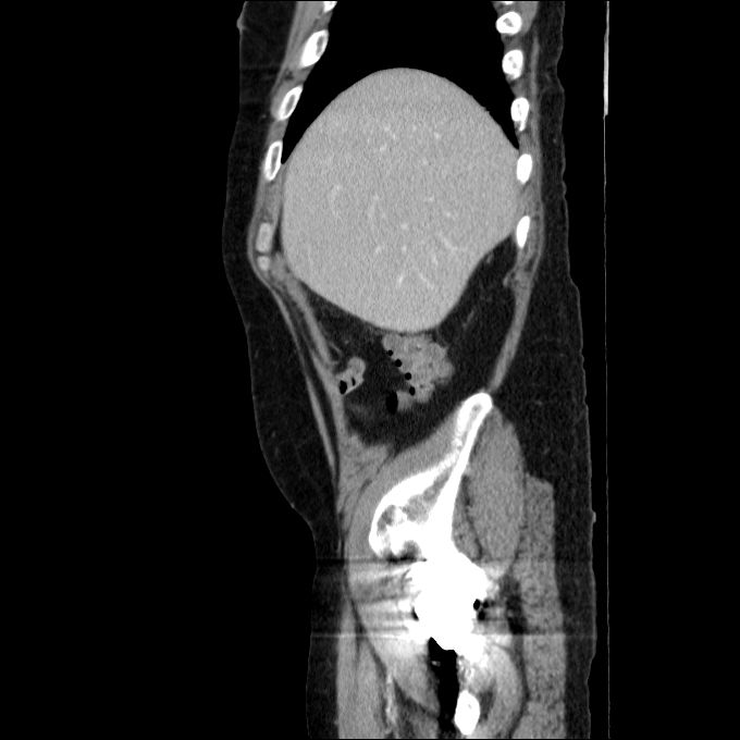 Acute cholecystitis and incidental left sided IVC (Radiopaedia 49352-54459 Sagittal C+ portal venous phase 74).jpg