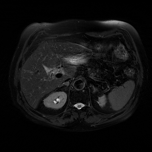 File:Acute cholecystitis complicated by pylephlebitis (Radiopaedia 65782-74915 Axial T2 fat sat 19).jpg
