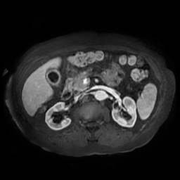 Acute cholecystitis complicated by pylephlebitis (Radiopaedia 65782-74915 Axial arterioportal phase T1 C+ fat sat 74).jpg