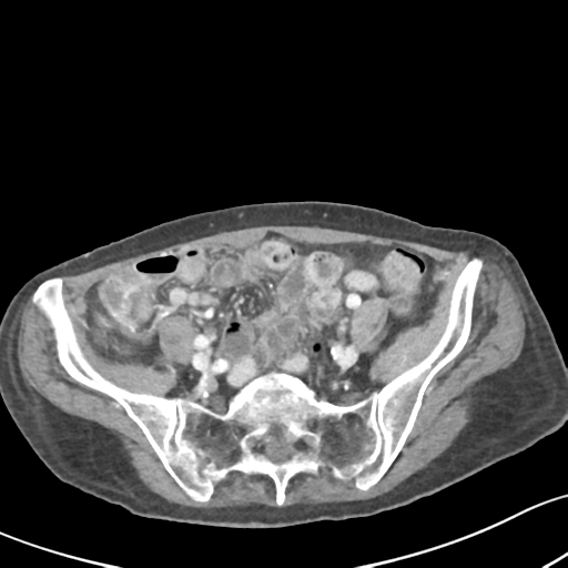 Acute cholecystitis with contained perforation (Radiopaedia 47328-51907 Axial C+ portal venous phase 53).png