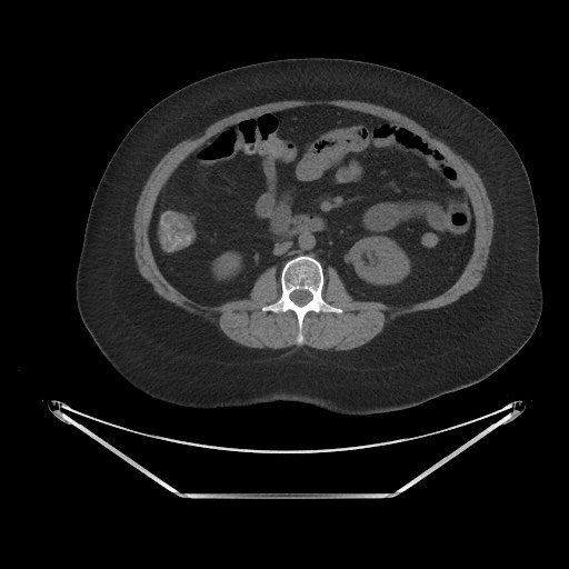Acute cholecystitis with tensile fundus sign (Radiopaedia 71394-81723 Axial non-contrast 43).jpg