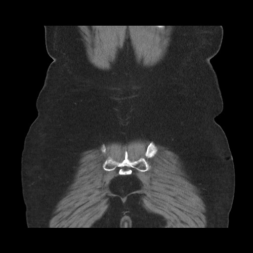 Acute cholecystitis with tensile fundus sign (Radiopaedia 71394-81723 Coronal non-contrast 107).jpg