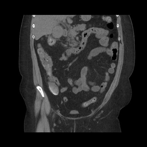Acute cholecystitis with tensile fundus sign (Radiopaedia 71394-81723 Coronal non-contrast 58).jpg