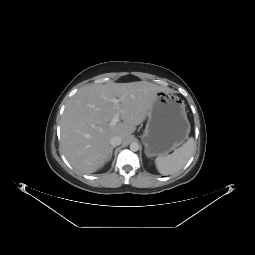 File:Acute complicated calculous cholecystitis (Radiopaedia 55202-61587 Axial C+ delayed 28).jpg