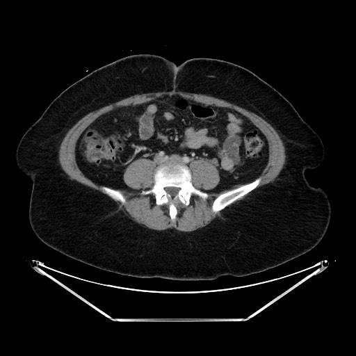 Acute diverticulitis - transverse colon (Radiopaedia 87063-103327 Axial C+ portal venous phase 101).jpg