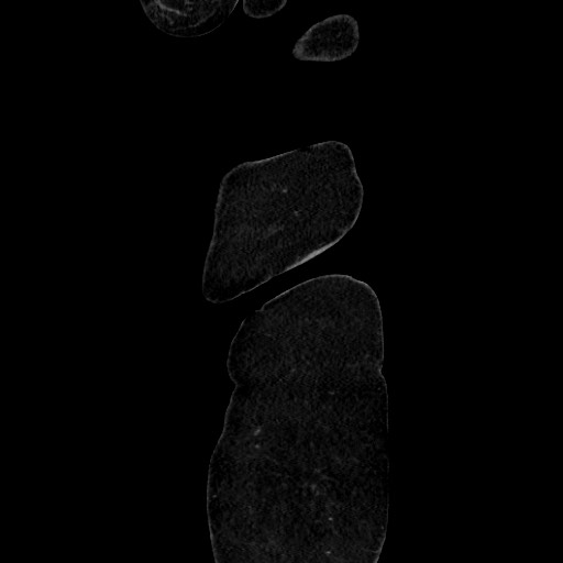 Acute diverticulitis - transverse colon (Radiopaedia 87063-103327 Sagittal C+ portal venous phase 21).jpg