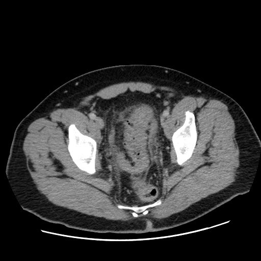Acute diverticulitis with localized perforation (Radiopaedia 41296-44113 Axial C+ portal venous phase 81).jpg