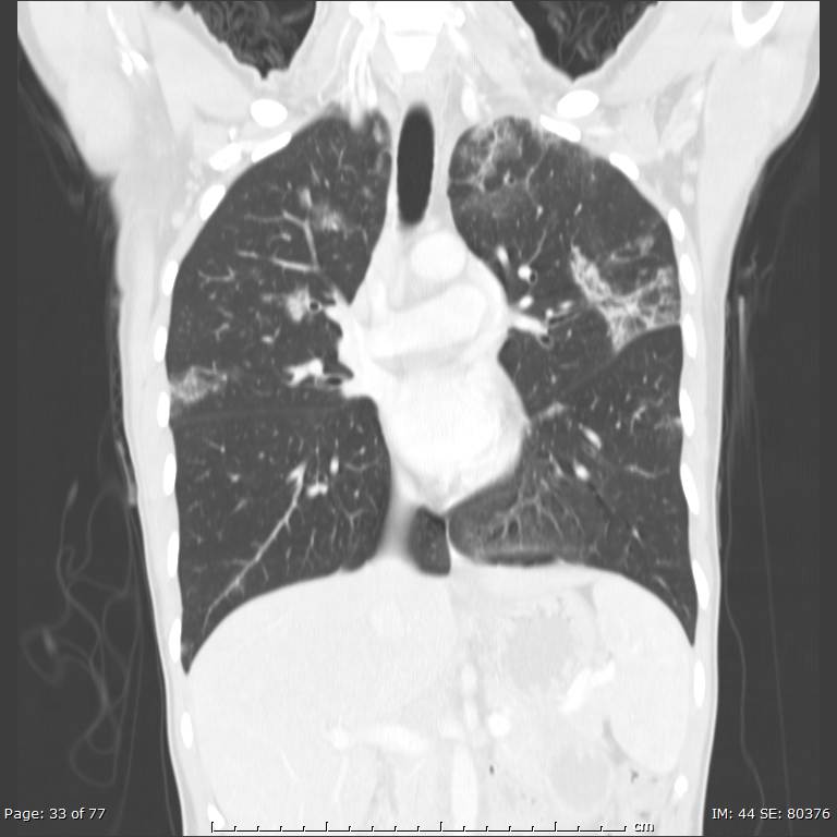 Acute eosinophilic pneumonia (Radiopaedia 48211-53073 Coronal lung window 22).jpg
