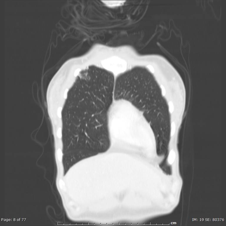 Acute eosinophilic pneumonia (Radiopaedia 48211-53073 Coronal lung window 4).jpg