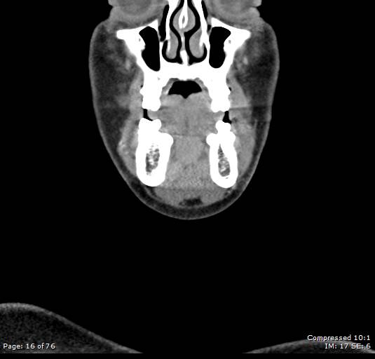 Acute epiglottitis (Radiopaedia 54375-60590 Coronal C+ arterial phase 16).jpg