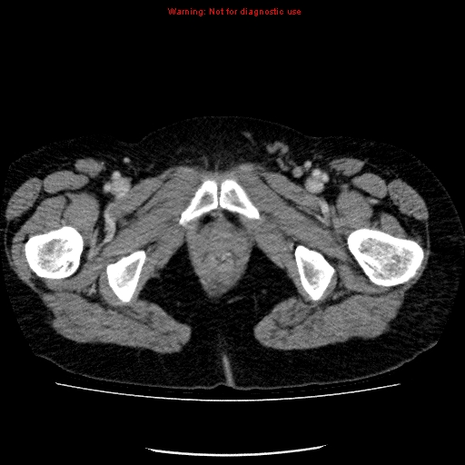 File:Acute gangrenous cholecystitis (Radiopaedia 10123-10661 Axial C+ portal venous phase 105).jpg