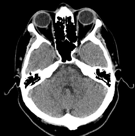 Acute internal carotid artery dissection (Radiopaedia 53541-59558 Axial non-contrast 16).jpg
