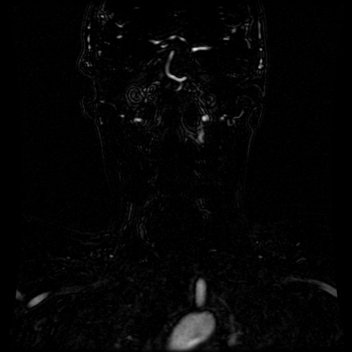 Acute internal carotid artery dissection (Radiopaedia 53541-59632 Coronal MRA 32).jpg