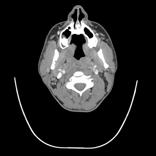 Acute longus colli calcific tendinitis (Radiopaedia 72495-83036 Axial C+ arterial phase 29).jpg