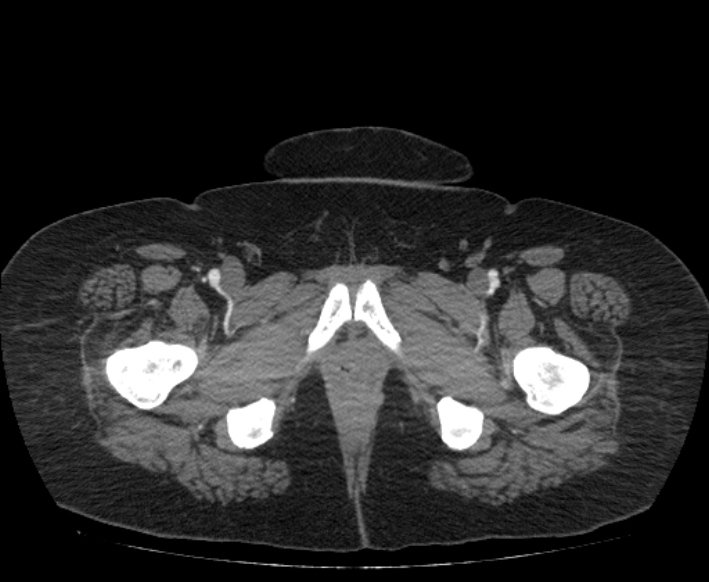 Acute mesenteric ischemia (Radiopaedia 80029-93316 Axial C+ arterial phase 141).jpg