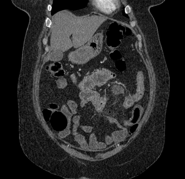 Acute mesenteric ischemia (Radiopaedia 80029-93316 Coronal C+ arterial phase 28).jpg