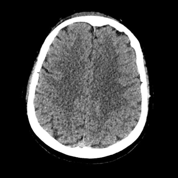 Acute middle cerebral artery territory infarct (Radiopaedia 52380-58283 Axial non-contrast 72).jpg