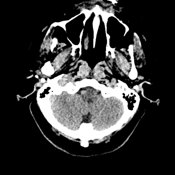 Acute middle cerebral artery territory infarct (Radiopaedia 52380-58283 Axial non-contrast 9).jpg