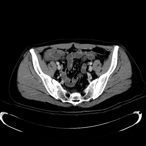 Acute myocardial infarction in CT (Radiopaedia 39947-42415 Axial C+ portal venous phase 104).jpg