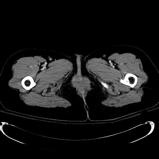 Acute myocardial infarction in CT (Radiopaedia 39947-42415 Axial C+ portal venous phase 153).jpg