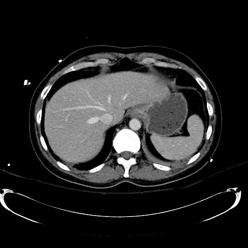 File:Acute myocardial infarction in CT (Radiopaedia 39947-42415 Axial C+ portal venous phase 22).jpg