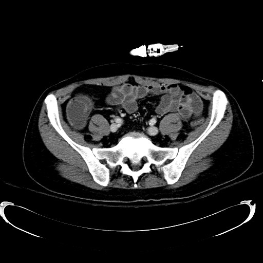 File:Acute myocardial infarction in CT (Radiopaedia 39947-42415 Axial C+ portal venous phase 94).jpg