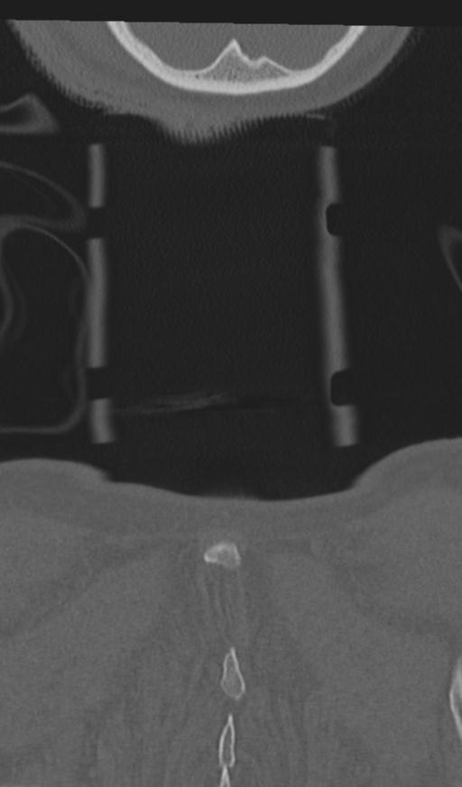 Acute on chronic subdural hematoma and thoracic vertebral injury in a multitrauma patient (Radiopaedia 31698-32619 Coronal bone window 77).jpg