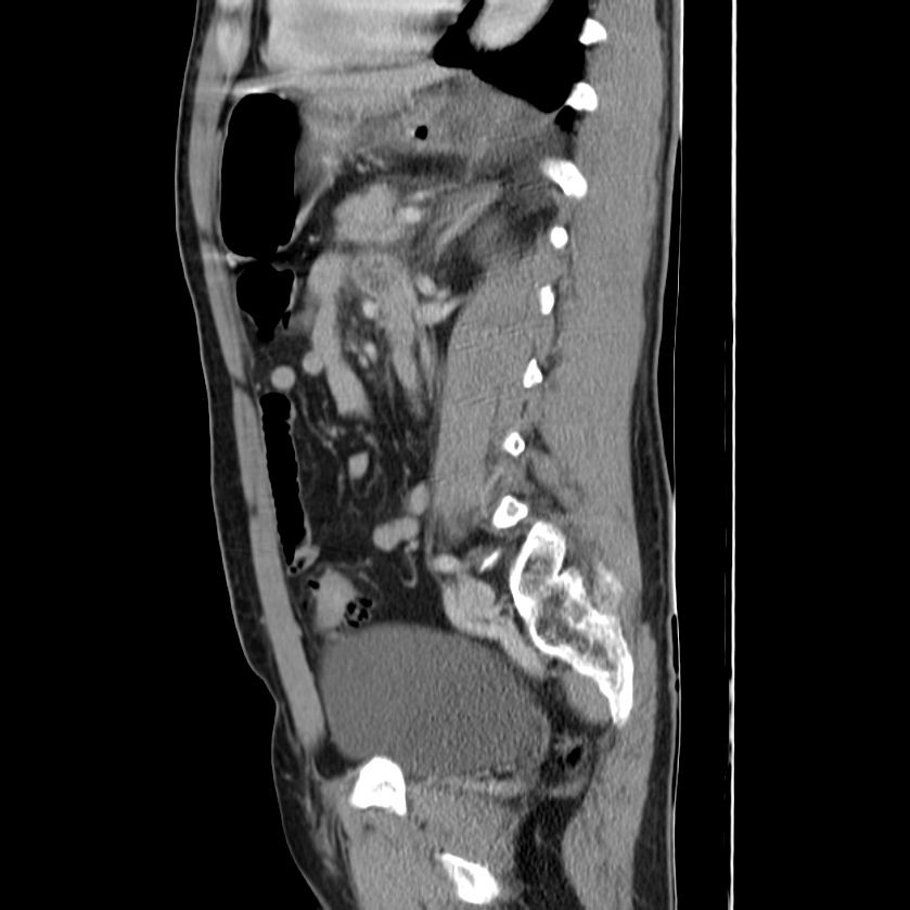 Acute pancreatitis (Radiopaedia 22572-22596 Sagittal C+ portal venous phase 34).jpg