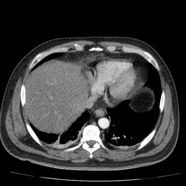Acute pancreatitis (Radiopaedia 26663-26813 Axial C+ arterial phase 14).jpg