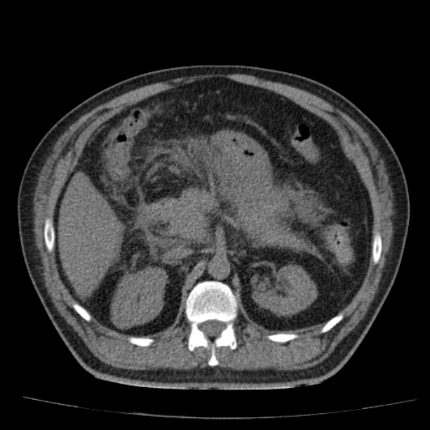 Acute pancreatitis (Radiopaedia 26663-26813 Axial non-contrast 38).jpg