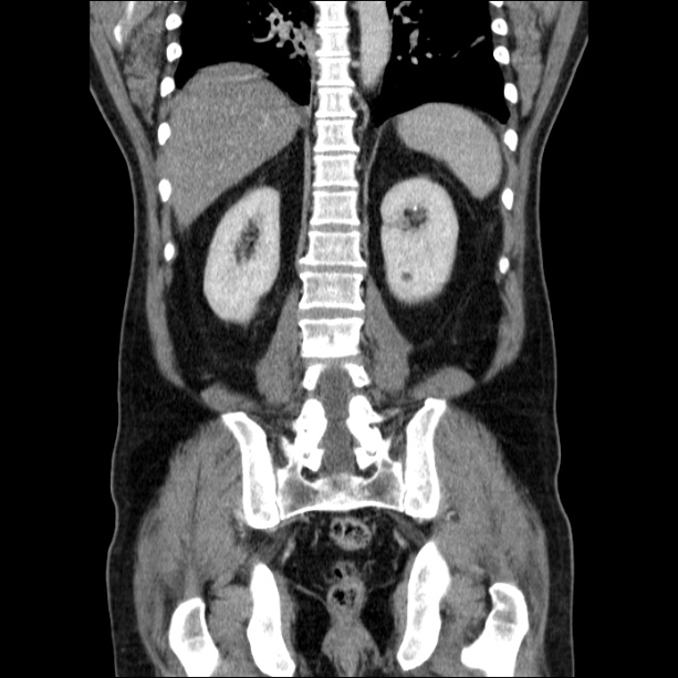 Acute pancreatitis (Radiopaedia 26663-26813 Coronal C+ portal venous phase 46).jpg