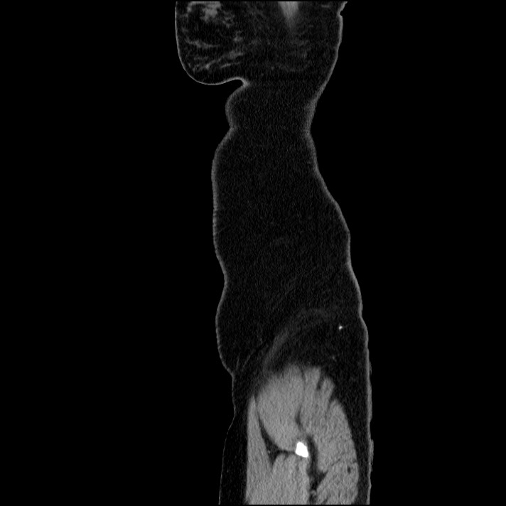 Acute pancreatitis (Radiopaedia 69236-79012 Sagittal C+ portal venous phase 12).jpg