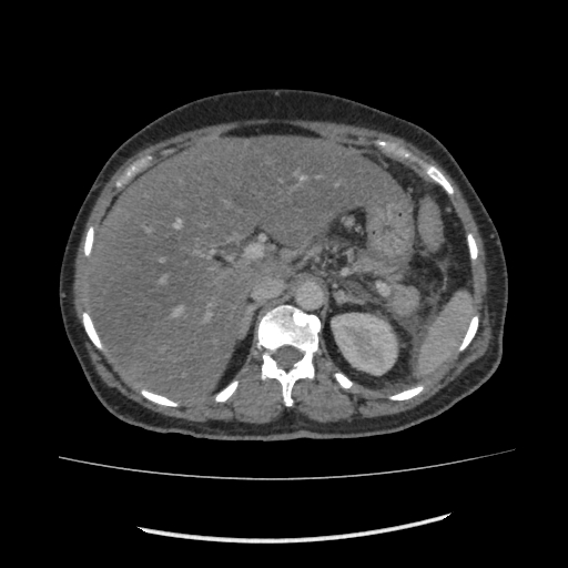 Acute pancreatitis (Radiopaedia 80007-93285 Axial C+ portal venous phase 34).jpg