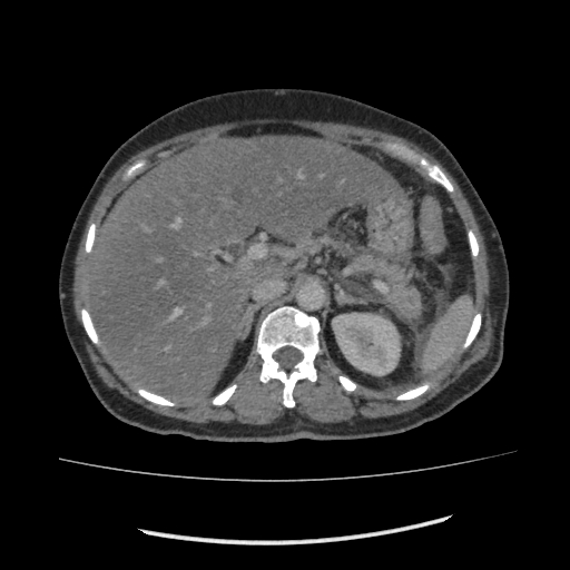 Acute pancreatitis (Radiopaedia 80007-93285 Axial C+ portal venous phase 36).jpg