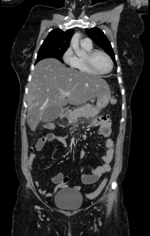 Acute pancreatitis (Radiopaedia 80007-93285 Coronal C+ portal venous phase 43).jpg