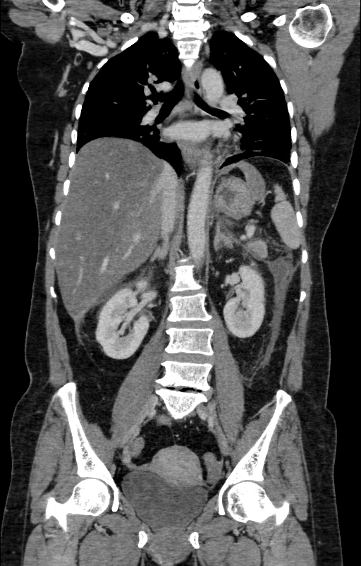 Acute pancreatitis (Radiopaedia 80007-93285 Coronal C+ portal venous phase 81).jpg