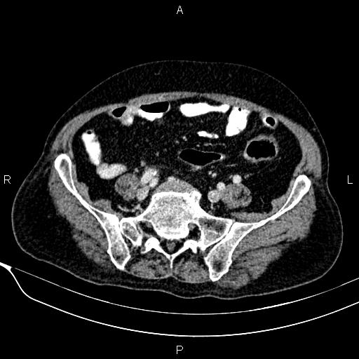 Acute pancreatitis (Radiopaedia 85146-100701 Axial C+ portal venous phase 48).jpg