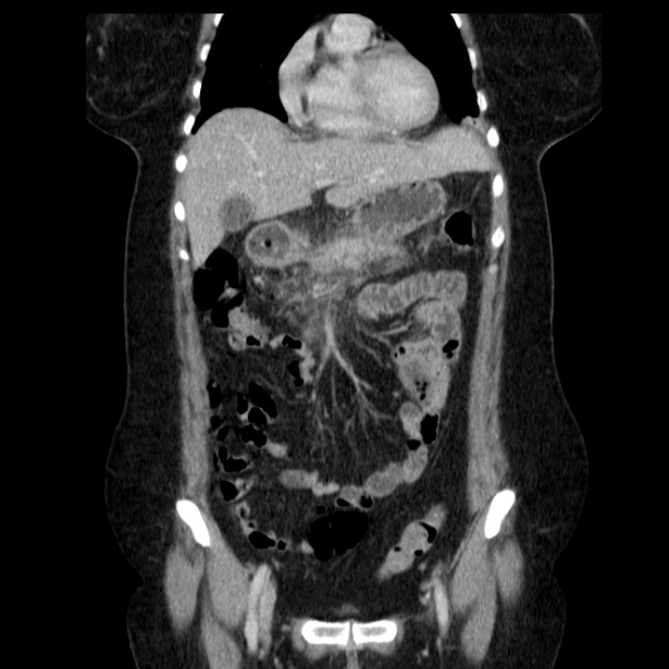 Acute pancreatitis - Balthazar C (Radiopaedia 26569-26714 Coronal C+ portal venous phase 25).jpg