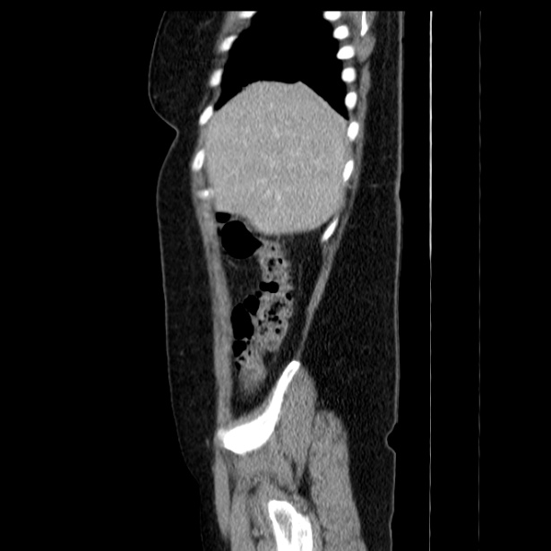 Acute pancreatitis - Balthazar C (Radiopaedia 26569-26714 Sagittal C+ portal venous phase 15).jpg