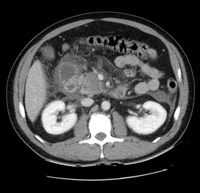 Acute pancreatitis - Balthazar E (Radiopaedia 23080-23110 Axial C+ portal venous phase 28).jpg