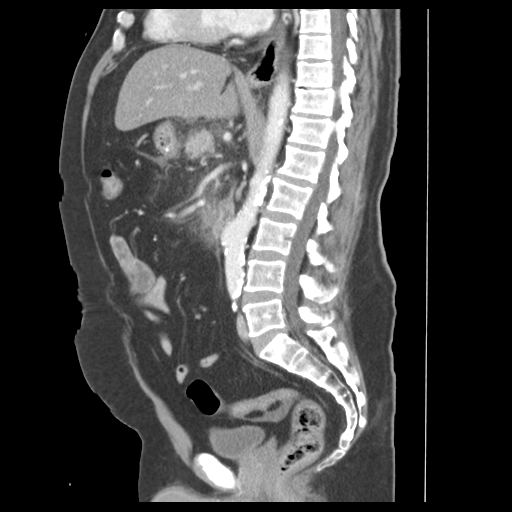 File:Acute pancreatitis complicated by portal vein thrombus (Radiopaedia 48148-52990 Coronal C+ portal venous phase 62).png