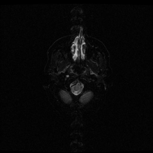File:Acute pontine infarct from vertebral artery dissection (Radiopaedia 34111-35370 Axial Echo planar 1).png