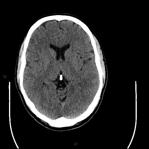 File:Acute posterior cerebral artery territory infarct (Radiopaedia 79329-92393 Axial non-contrast 53).jpg