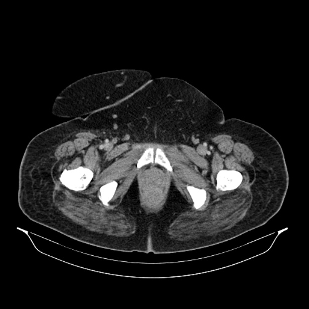 Acute pyelonephritis (Radiopaedia 25657-25837 Axial renal parenchymal phase 83).jpg