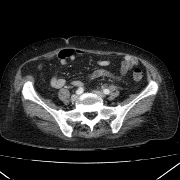 Acute pyelonephritis (Radiopaedia 26584-26729 Axial renal cortical phase 53).jpg
