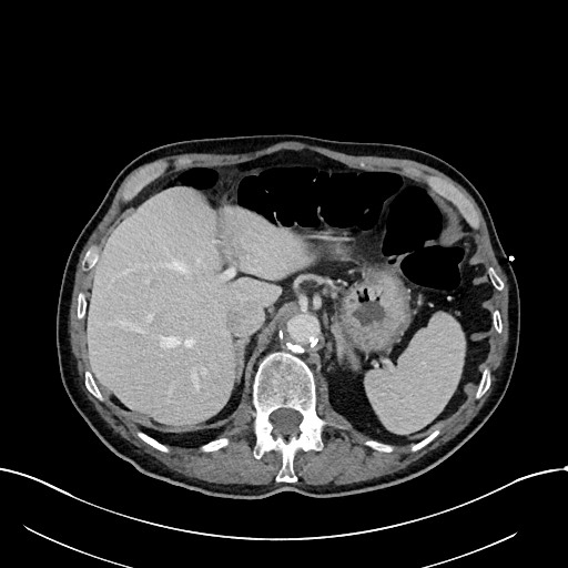 File:Acute renal infarction (Radiopaedia 59375-66736 Axial C+ portal venous phase 21).jpg