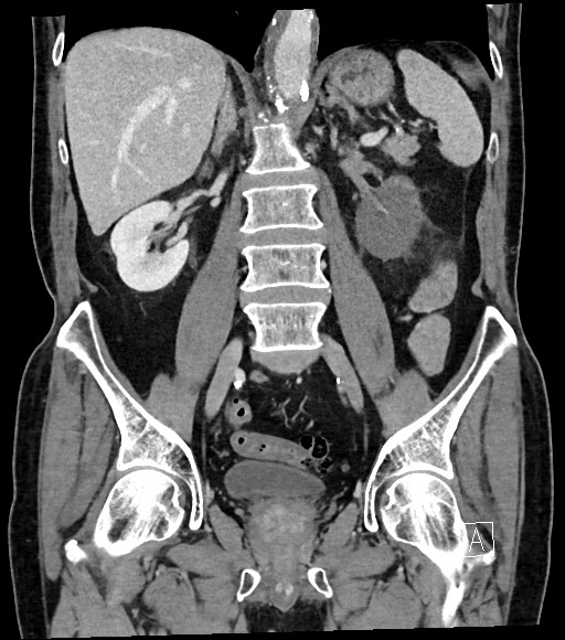 Acute renal infarction (Radiopaedia 59375-66736 Coronal C+ portal venous phase 37).jpg