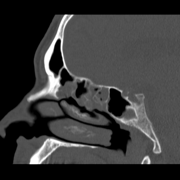 Acute sinusitis (Radiopaedia 23161-23215 Sagittal bone window 30).jpg
