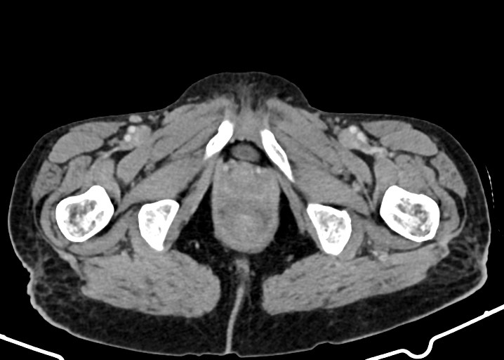 Acute small bowel (ileal) volvulus (Radiopaedia 71740-82139 Axial C+ portal venous phase 207).jpg