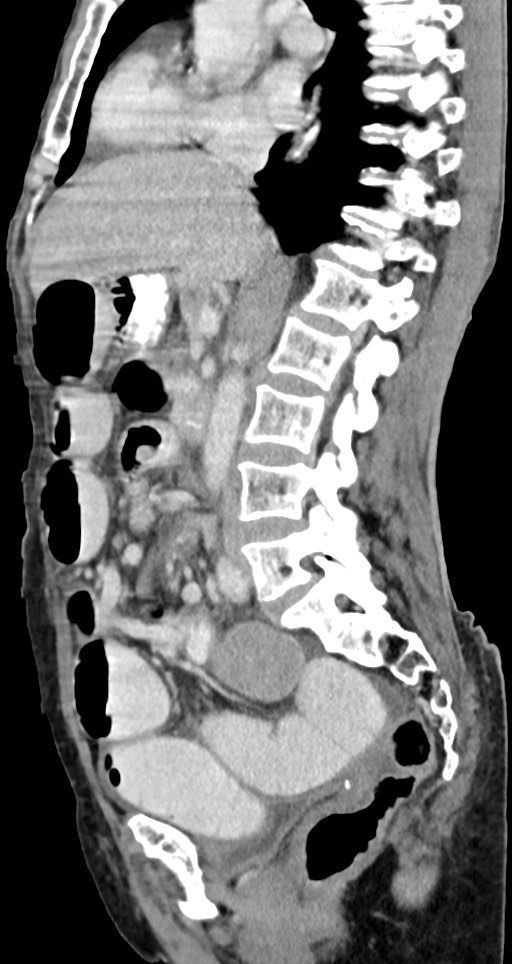 Acute small bowel (ileal) volvulus (Radiopaedia 71740-82139 Sagittal C+ portal venous phase 93).jpg